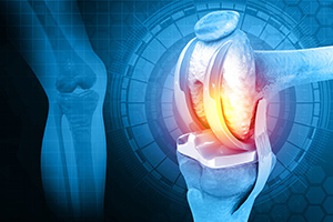 The Future of Knee Surgery: Exploring the Benefits of CORI™ Robotic Knee Replacement