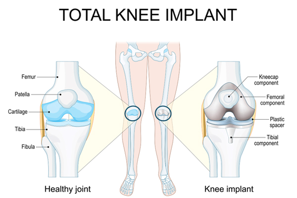 Why Your Implant Fit Matters in Knee Replacement — And How Robotics Gets It Right
